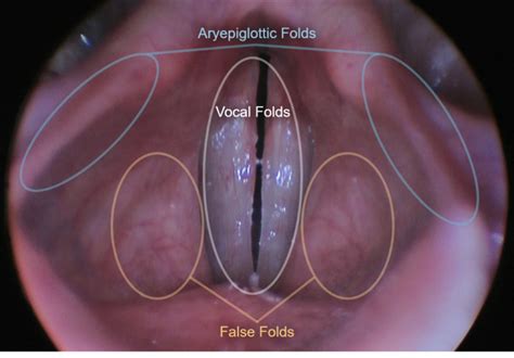 False Vocal Folds