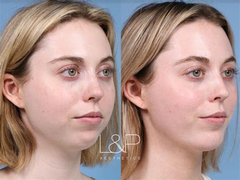 Fat In Face Surgery