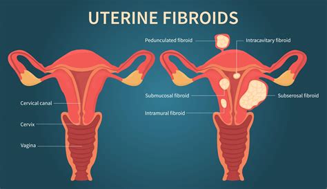 Fibroids Bursting Feels Like