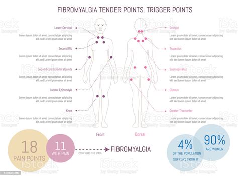 Fibromyalgia Trigger Points