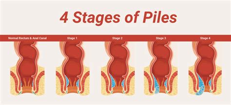 Fissures Or Piles