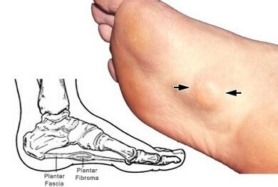 Foot Lump On Arch