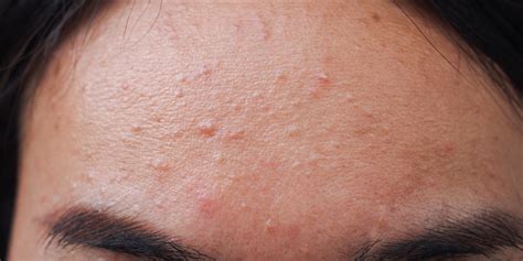 Fungal Acne Forehead
