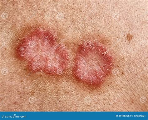 Fungus On Skin