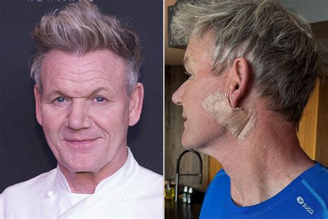 Gordon Ramsay Face Surgery