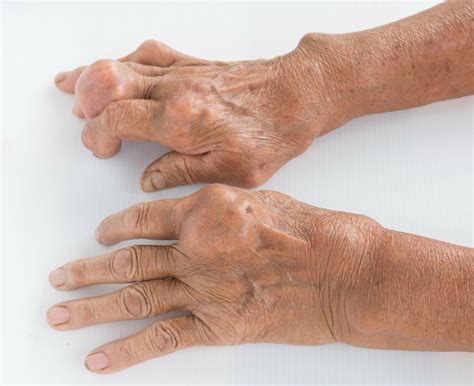 Gout In Hands