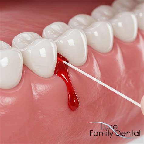 Gums Bleed When Flossing