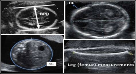 Hc Ultrasound Meaning