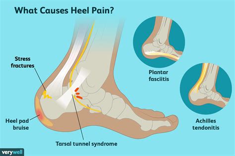 Heel Ache In The Morning