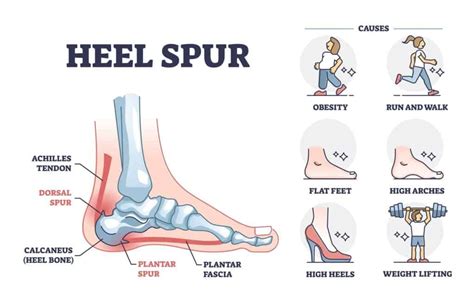 Heel Spurs Treatment