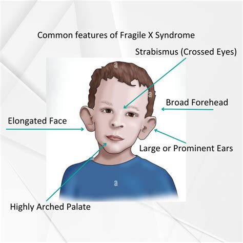 How Common Is Fragile X Syndrome