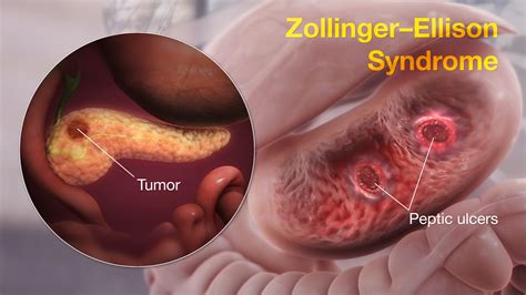 How Common Is Zollinger Ellison Syndrome