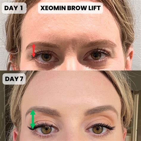 How Long Before Xeomin Kicks In