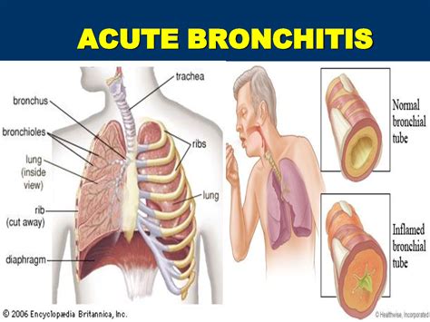 How Long Does Bronchitis Last