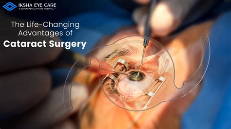 How Long Is Cataract Surgery