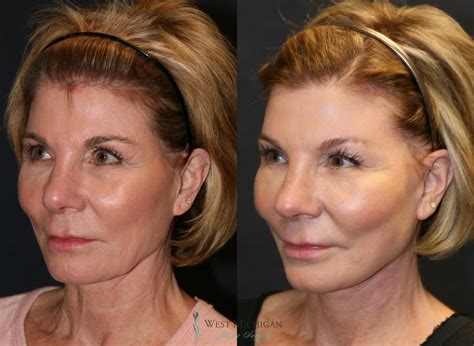 How Much Does Face Surgery Cost