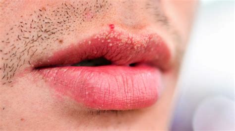 Hpv Bumps On Lips