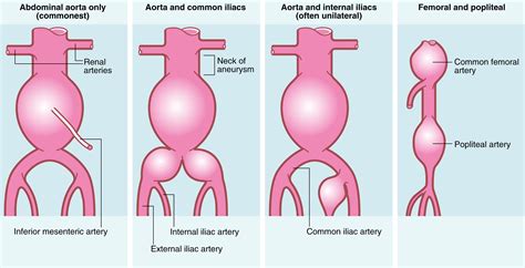 Iliac Artery Aneurysm