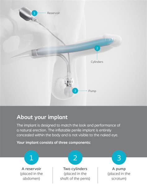 Inflatable Penile Implant Cost