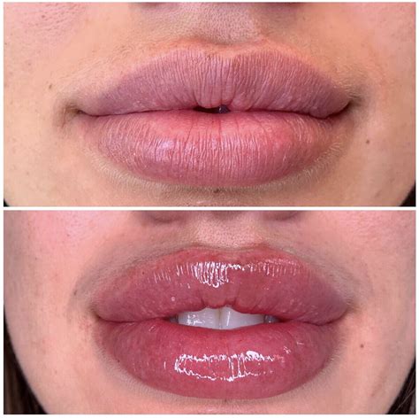 Injecting Lip Fillers