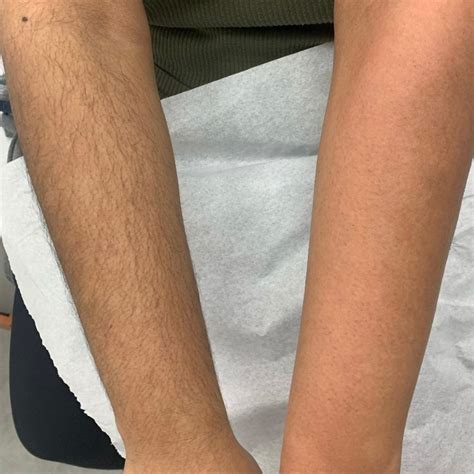 Is It Normal To Bleed When Waxing