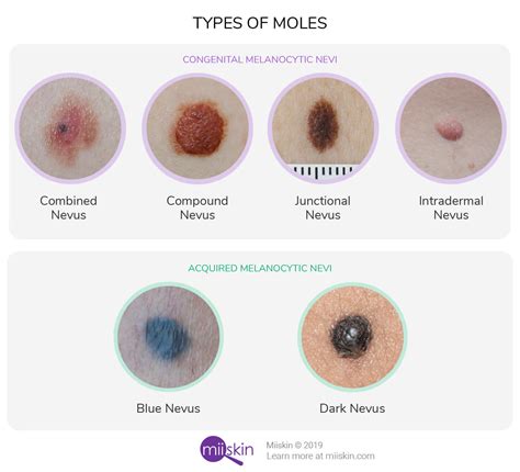 Is It Normal To Develop New Moles