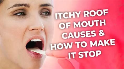 Itchy Roof Of Mouth