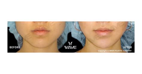 Jaw Shaving Surgery Process