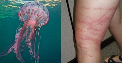 Jellyfish Why Do They Sting