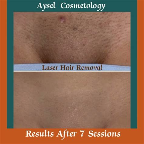 Laser Hair Removal Pubic Area