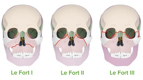 Lefort 3 Fracture