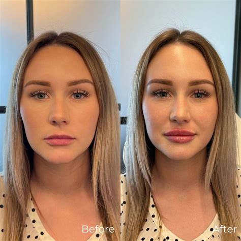 Lip Filler Before After