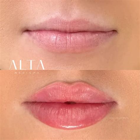 Lip Injection Filler