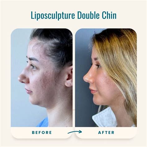 Liposculpture Double Chin