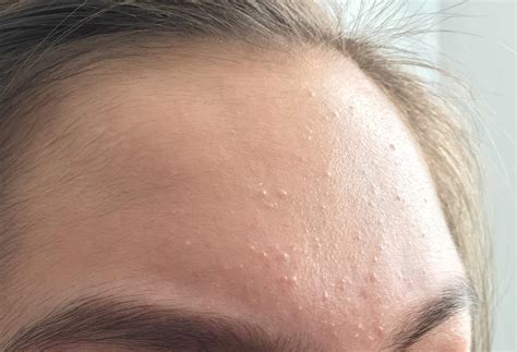 Little Bumps On Face