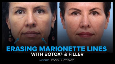 Marionette Lines Filler