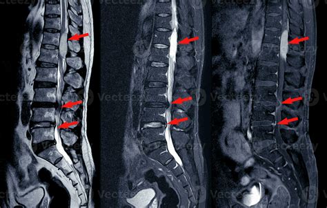 Mass On Spine Symptoms