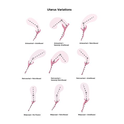Meaning Anteverted Uterus