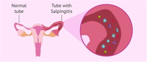 Medical Term Salping/O