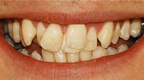 Messed Up Teeth