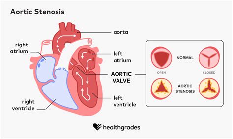 Mild Aortic Stenosis