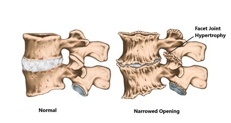 Mild Facet Hypertrophy
