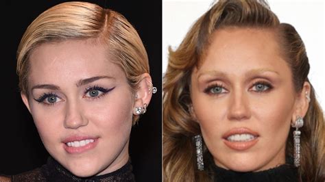 Miley Cyrus' Face Surgery