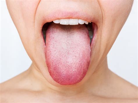 My Tongue Is Whitish