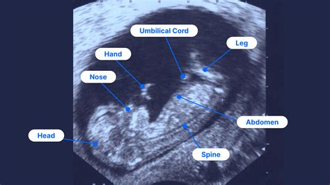 N T Sonography