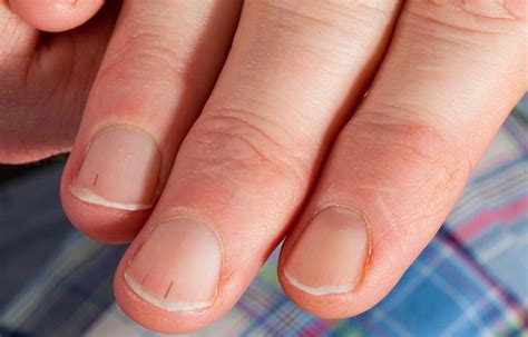 Nail Bed Splinter Hemorrhages