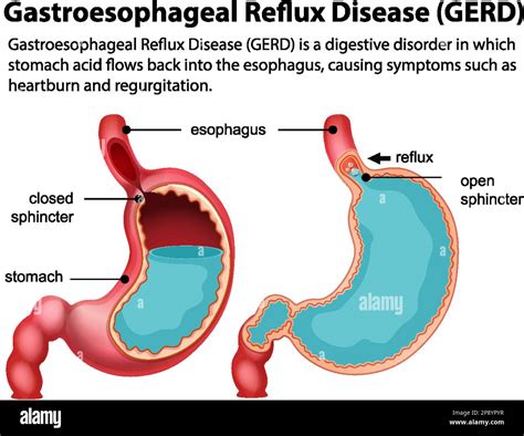 Nonerosive Reflux Disease