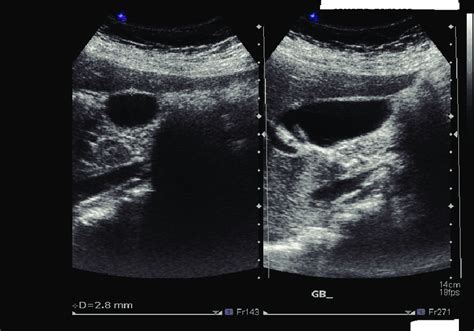 Normal Gallbladder Wall Thickness