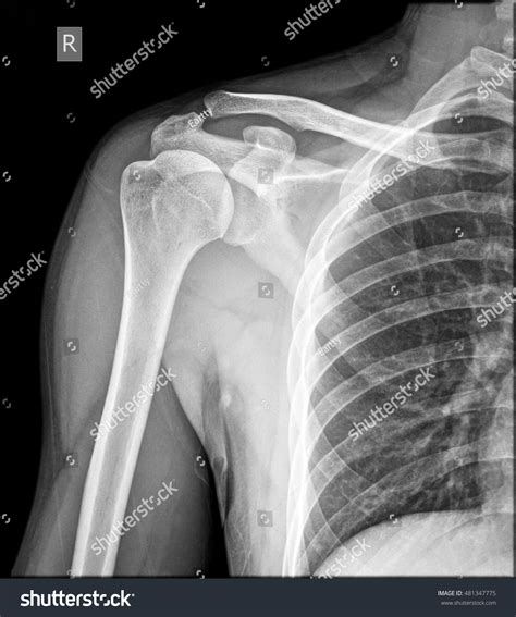 Normal Shoulder X Ray
