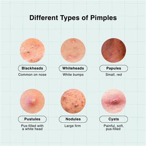 Nose Pimple Means